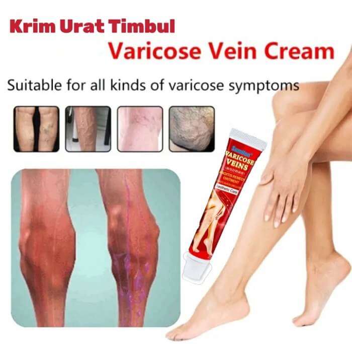  Varicose Veins Angiitis Ointment Herbal Cream In AjmanShop 